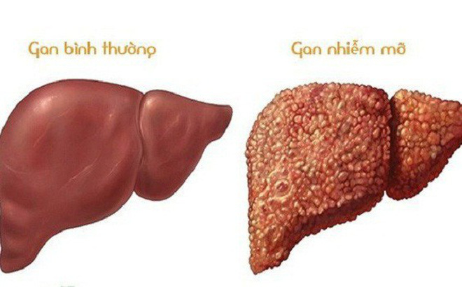 gan nhiễm mỡ là gì